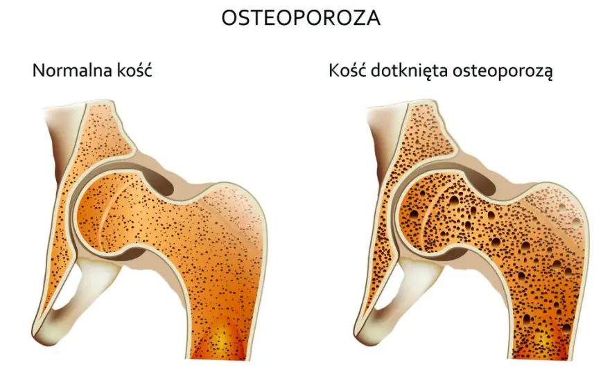 Osteoporoza przyczyny: Jak uniknąć utraty gęstości kości?