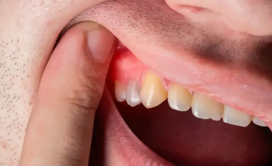 Ropa w dziąśle: Co robić? Szybka ulga i kiedy do dentysty