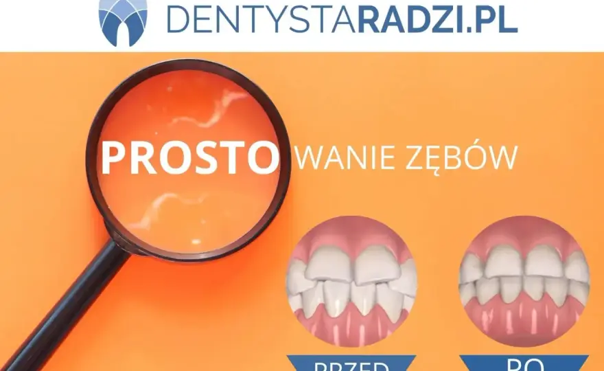 Prostowanie zębów - Czy warto? Koszty, czas, metody i efekty