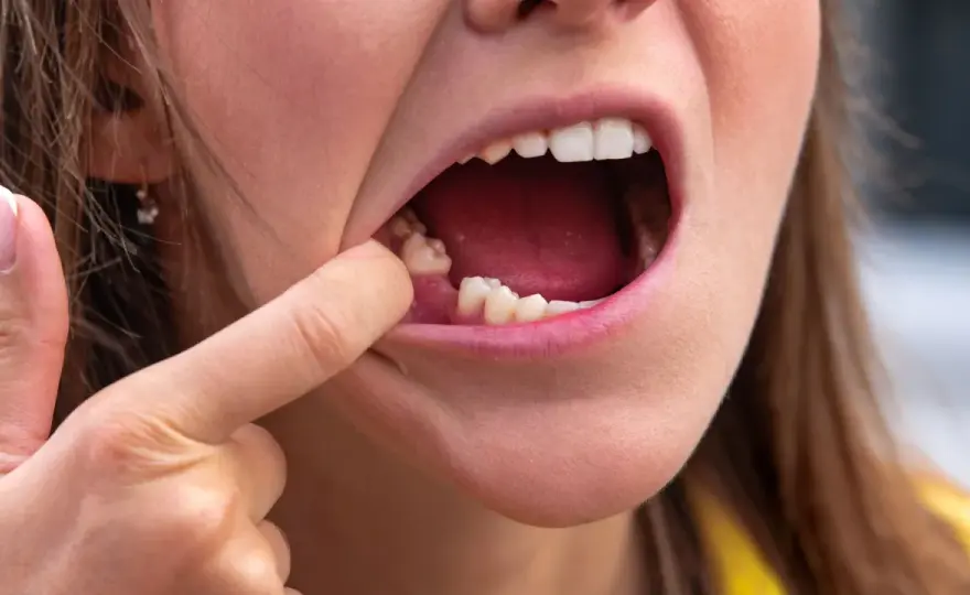 Luxación dental tras un golpe - qué hacer y cuándo acudir