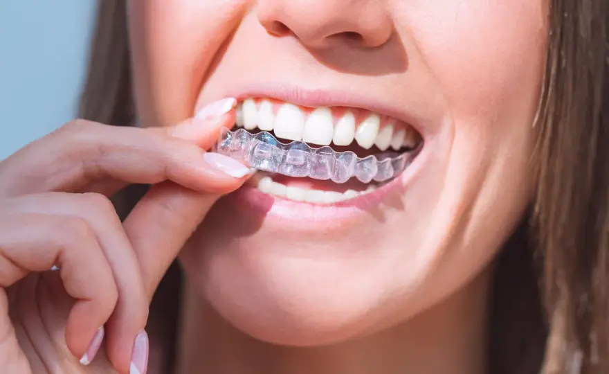 Cómo limpiar un Invisalign amarillo sin dañarlo