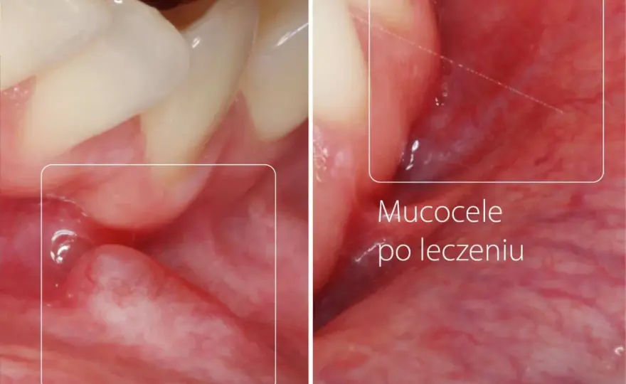 Torbiel w jamie ustnej - Kiedy to mucocele, a kiedy dentysta?
