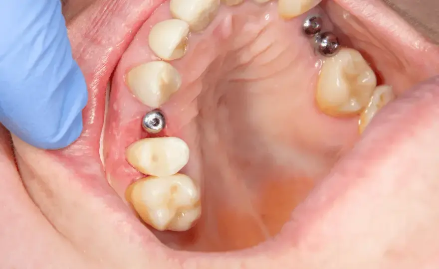 Implant zęba: Poznaj fakty! Zabieg, zalety, cena Twój nowy uśmiech
