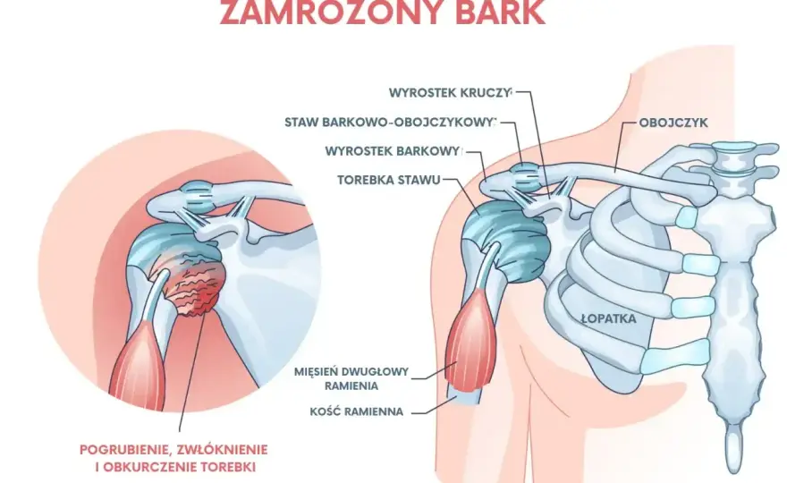 Bark czy ramię? Rozróżnij i unikaj kontuzji w sporcie!