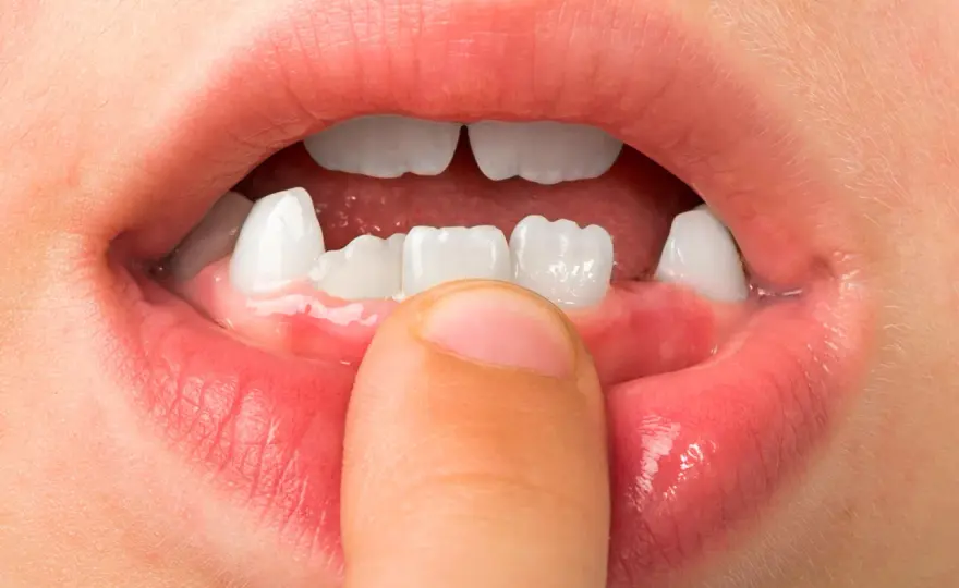 ¿A qué edad se caen los colmillos de leche?