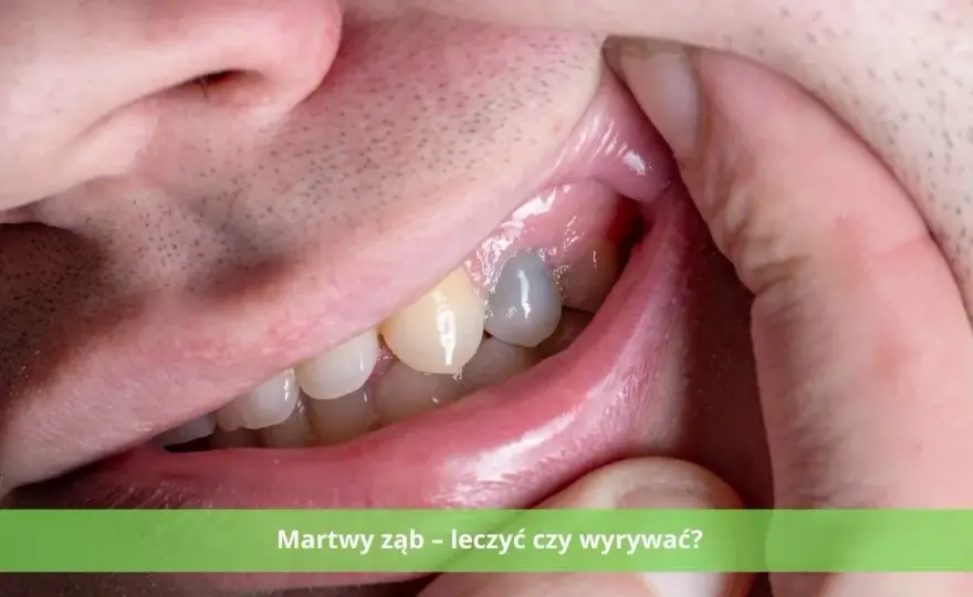Martwy ząb: leczyć czy usunąć? Co wybrać? Koszty i zdrowie
