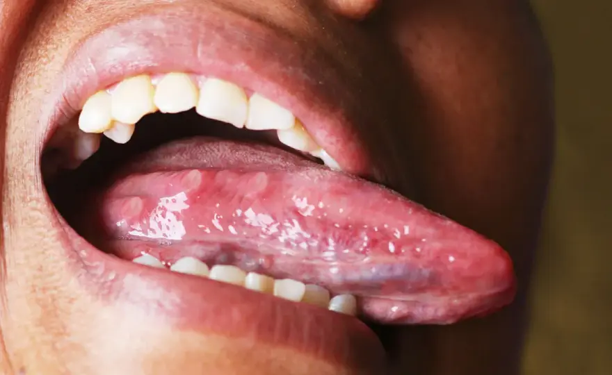 ¿Llaga en la lengua? Causas, alivio y cuándo consultar