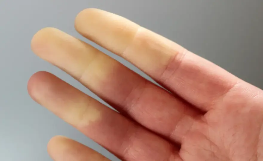 Objaw Raynauda - Czy to tylko zimne palce? Rozpoznaj i działaj!
