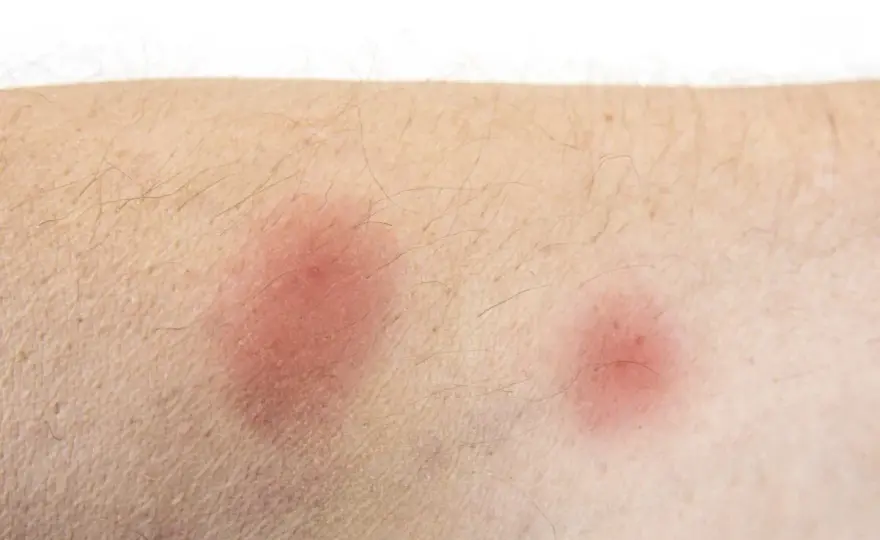 Hausstaubmilben Allergie Symptome: So erkennen Sie die Anzeichen