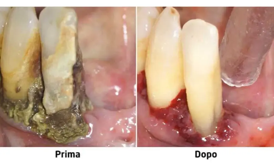 Dopo quanto cadono i denti con la piorrea? Cosa sapere