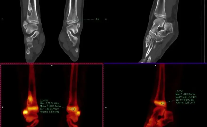 Co to jest SUV max i dlaczego jest kluczowy w diagnostyce?