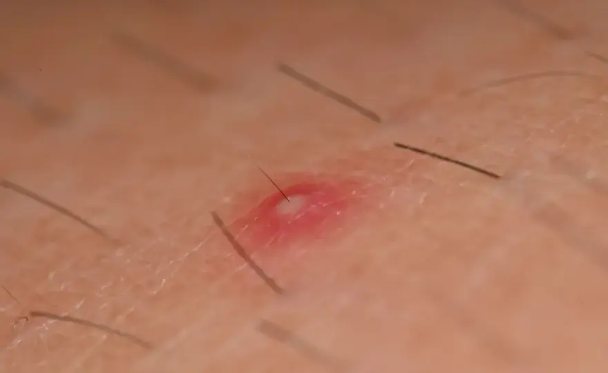 Bolesne krosty pod pachą - Co robić i kiedy do lekarza?