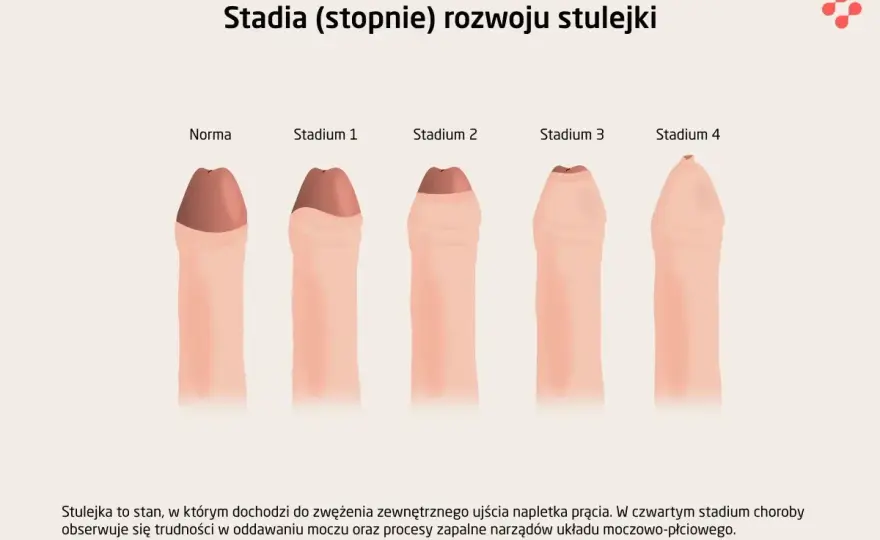 Zwężony napletek u chłopca - Kiedy to norma, a kiedy leczyć?