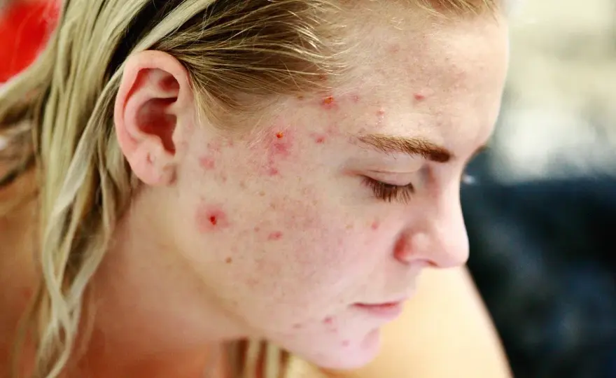 Grano interno doloroso - qué hacer y cuándo ir al dermatólogo