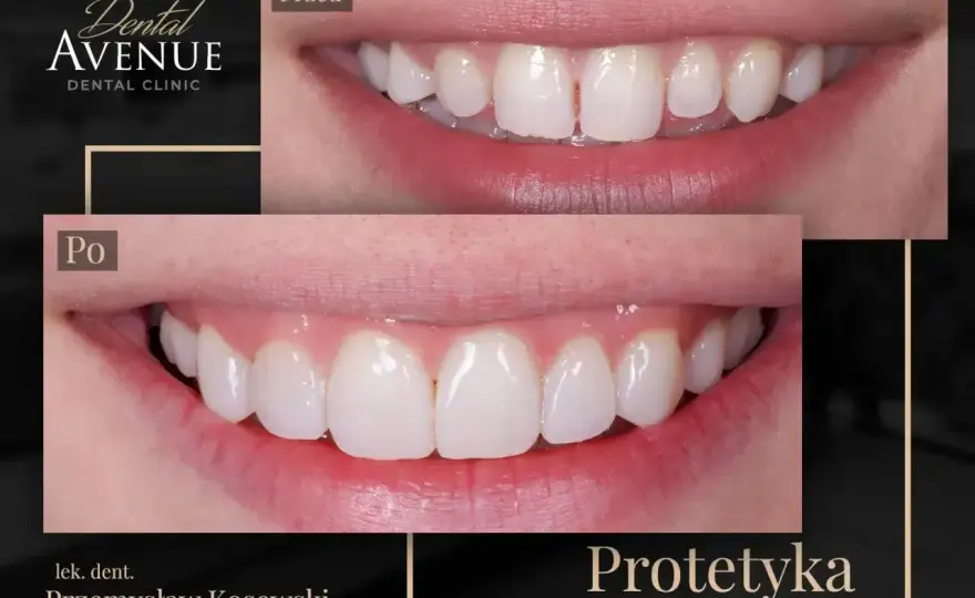 Licówki kompozytowe - Czy to rozwiązanie dla Ciebie? Sprawdź!
