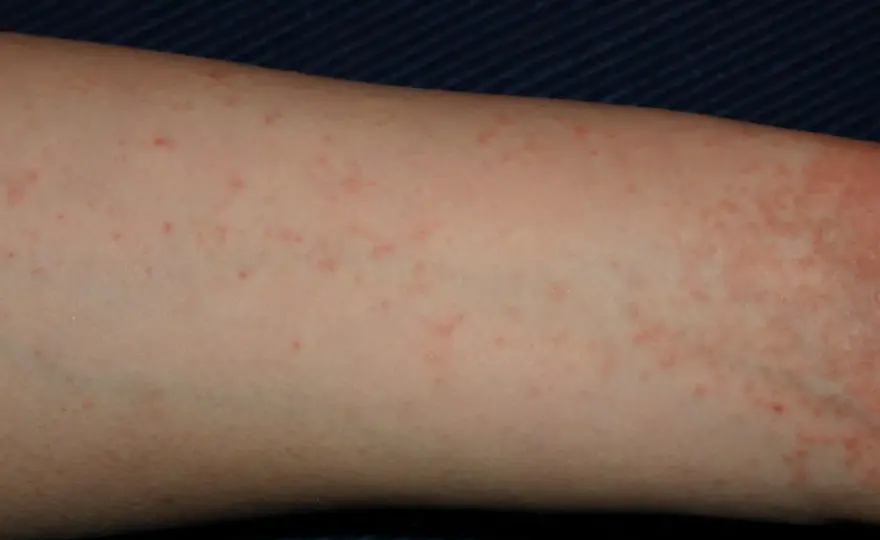 Falsa scabbia nei bambini, come riconoscerla?