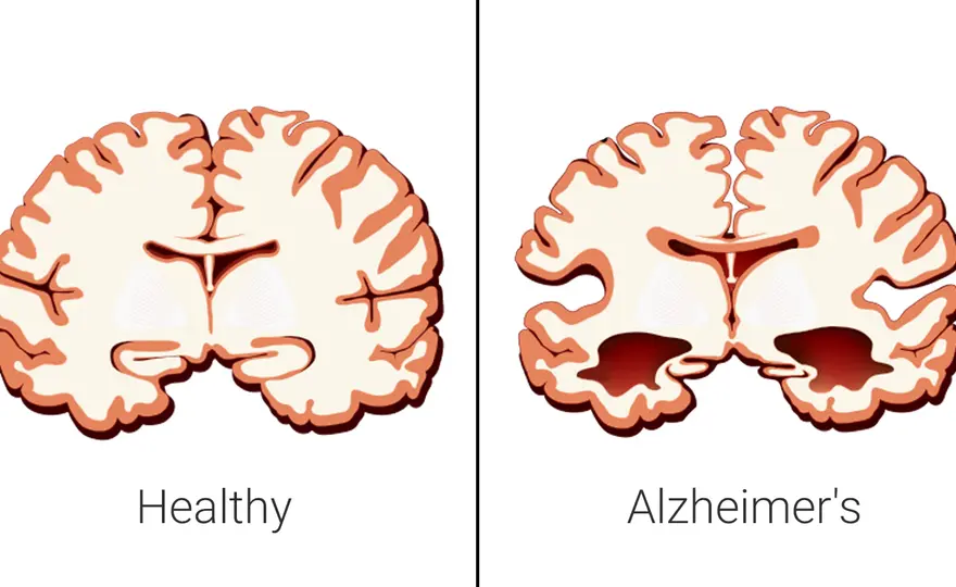 Choroba Alzheimera: neurologiczna czy psychiczna? Rozwiewam wątpliwości