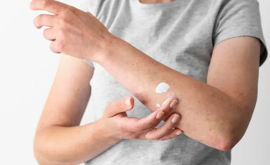 Hongos en la piel: ¿Por qué aparecen y cómo evitarlos?
