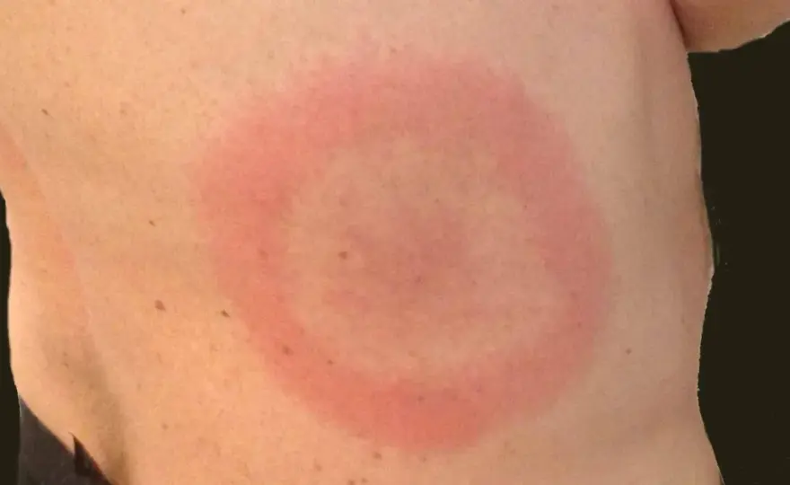 Bebis utslag och allergi - skilj på eksem, skorv och nässelutslag
