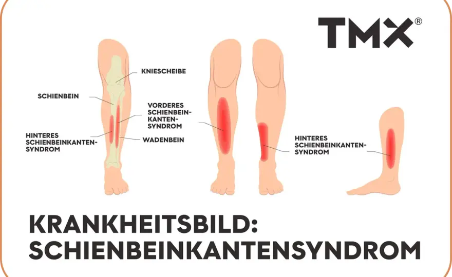 Schienbeinkantensyndrom verstehen - Schmerzfrei Sport treiben