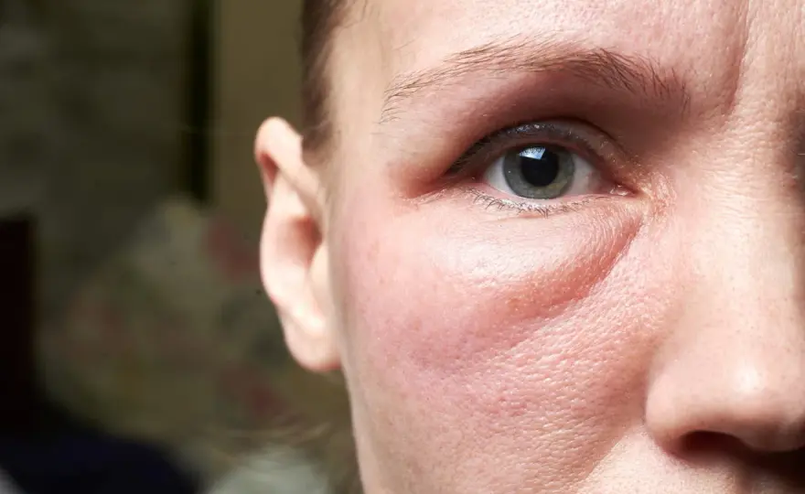 Visage gonflé pendant les règles - causes et solutions