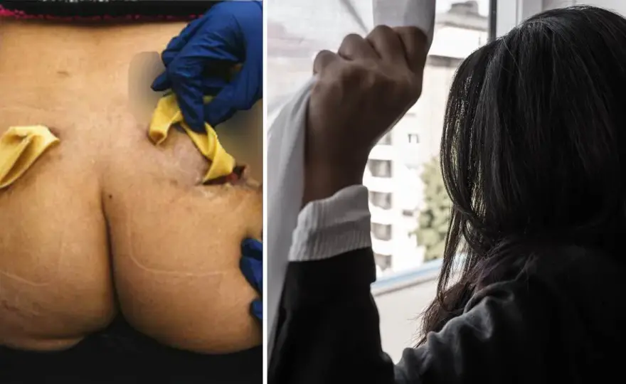 Fillers i rumpan - Kostnad, risker och resultat i Sverige