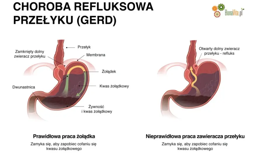 Refluks czy nerwica żołądka? Odróżnij objawy i działaj!