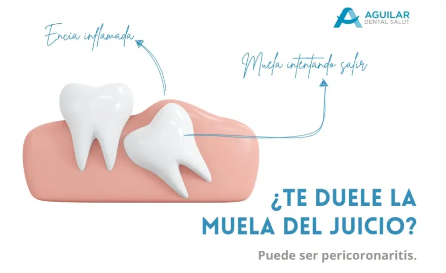 ¿Puede una muela del juicio causar dolor de cabeza?