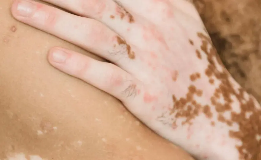 Pigmentbrist i huden - Vitiligo eller något annat?