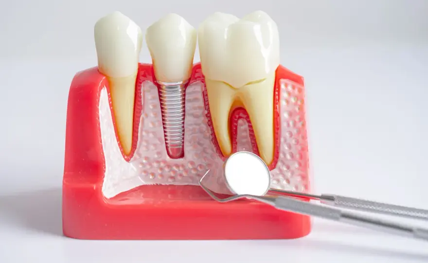 Denti fissi dopo la piorrea? Cosa sapere prima degli impianti
