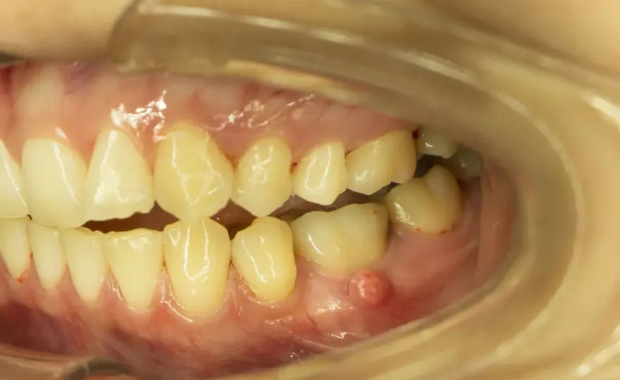 Ropień na dziąśle - co pomaga i kiedy pilnie iść do dentysty?