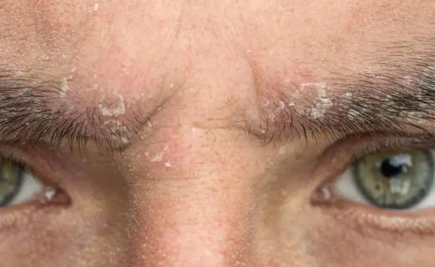 Seborrea facial - Controla el brillo sin irritar tu piel