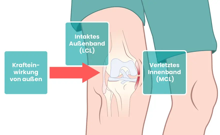 Innenband Knie - Heilung, Behandlung & Reha verstehen