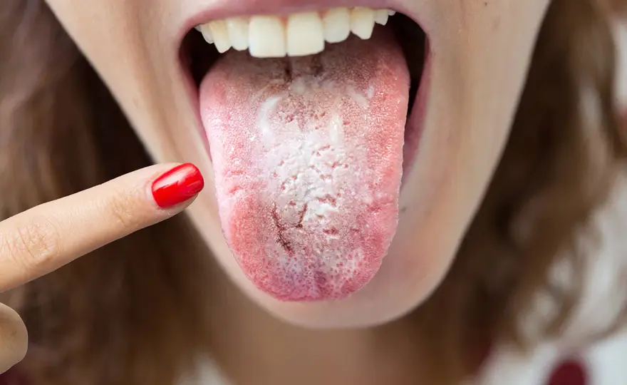 Lengua áspera y seca - causas y cuándo consultar