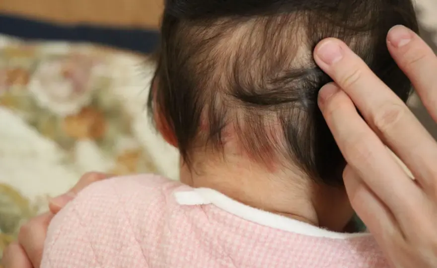Macchia rosa neonato - Morso della cicogna, quando preoccuparsi?