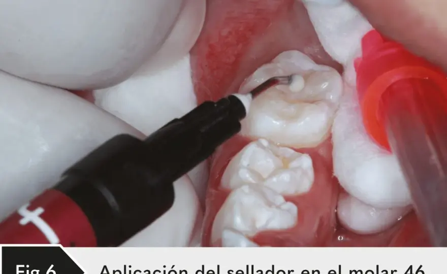 Sellador dental para molares - cuándo conviene y cuánto dura