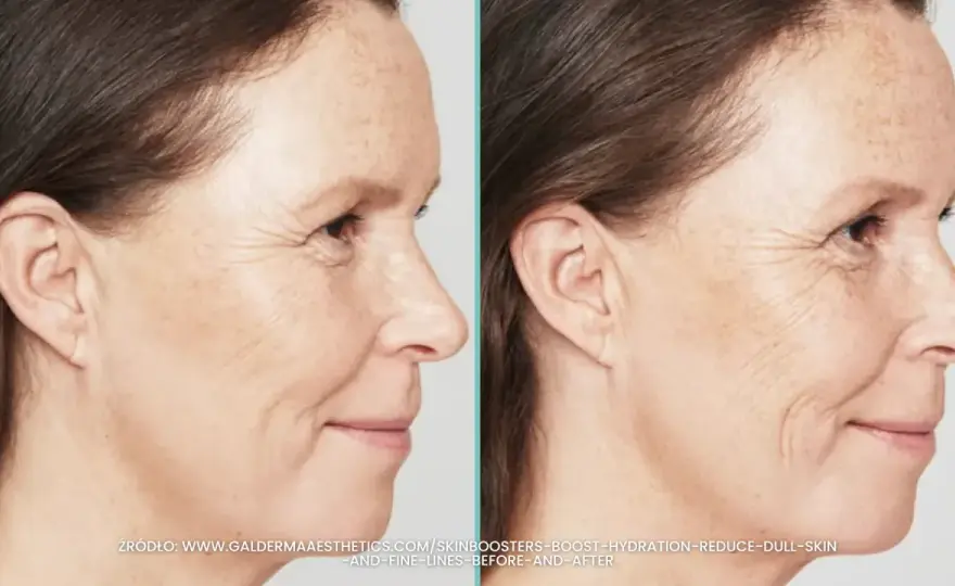 Skinbooster - Co to jest? Cena, efekty, dla kogo ma sens?