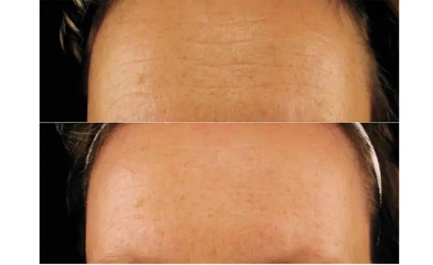 Kolagen na twarz - Realne efekty i po jakim czasie je zobaczysz?