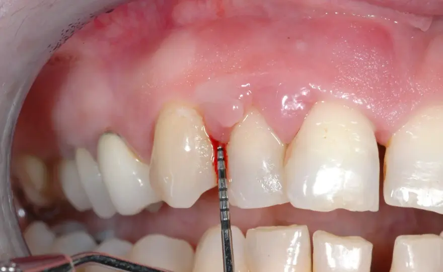 Pulizia dei denti - Rovine o protegge? La verità