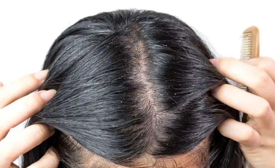 Dermatite seborroica del cuoio capelluto, cosa fare?