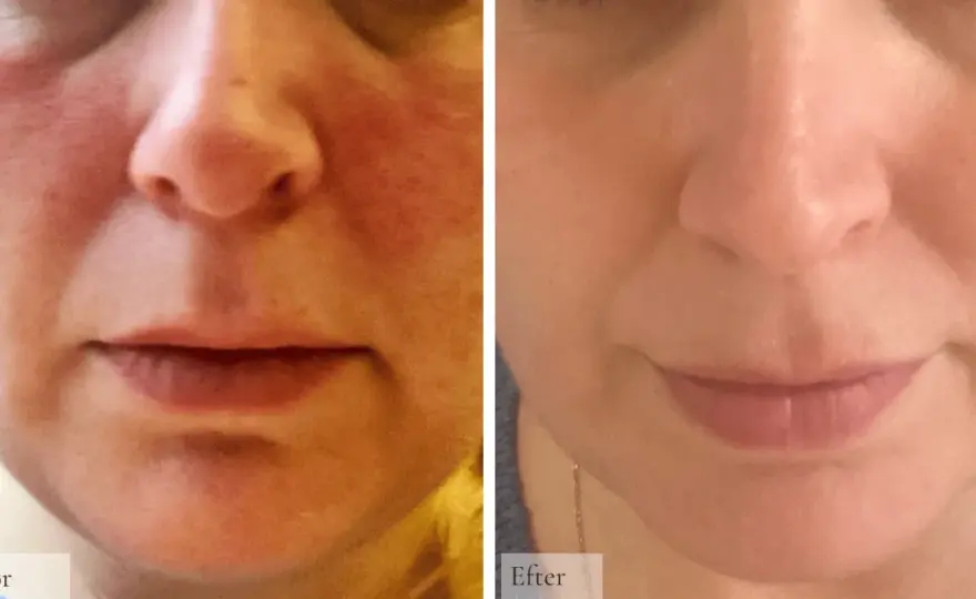 Rosacea - Känna igen, behandla och lugna din hud