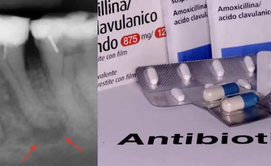 Ascesso dentale - Antibiotico? Quando serve davvero