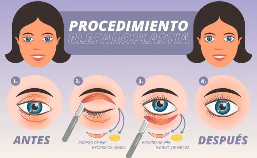 Blefaroplastia - Párpados caídos: ¿Qué corrige y cuánto cuesta?