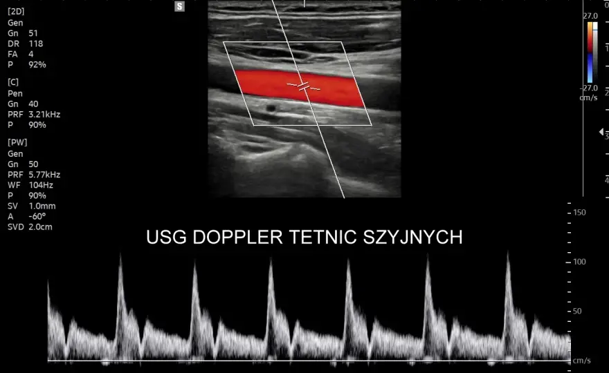 USG Doppler tętnic szyjnych - Profilaktyka udaru i co oznaczają wyniki