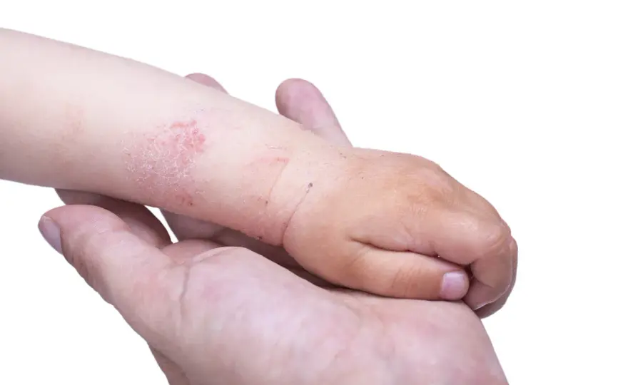 Eczema nei bambini - sintomi, cure e quando sentire il pediatra