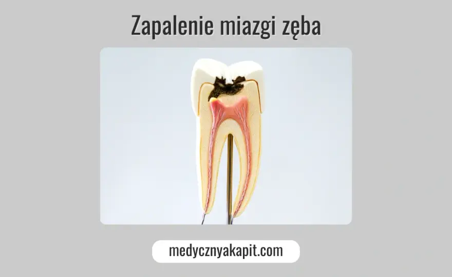 Miazga zęba - jak rozpoznać zapalenie i uniknąć leczenia kanałowego?