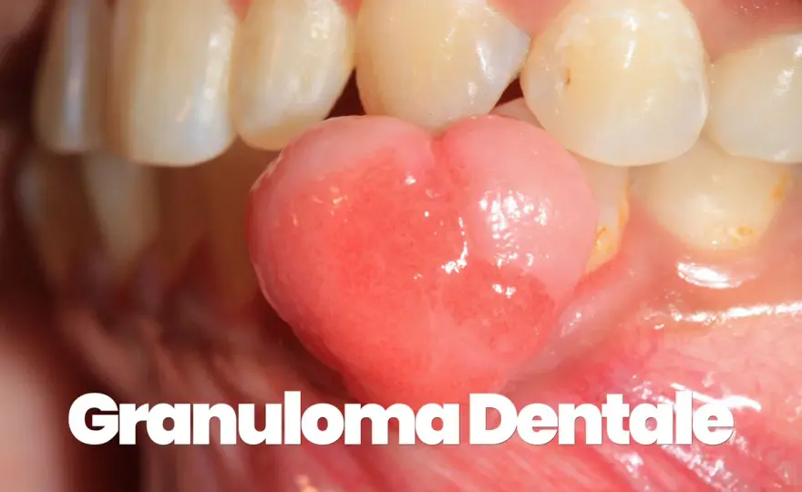 Granuloma gengivale: cos'è, cause e cura definitiva