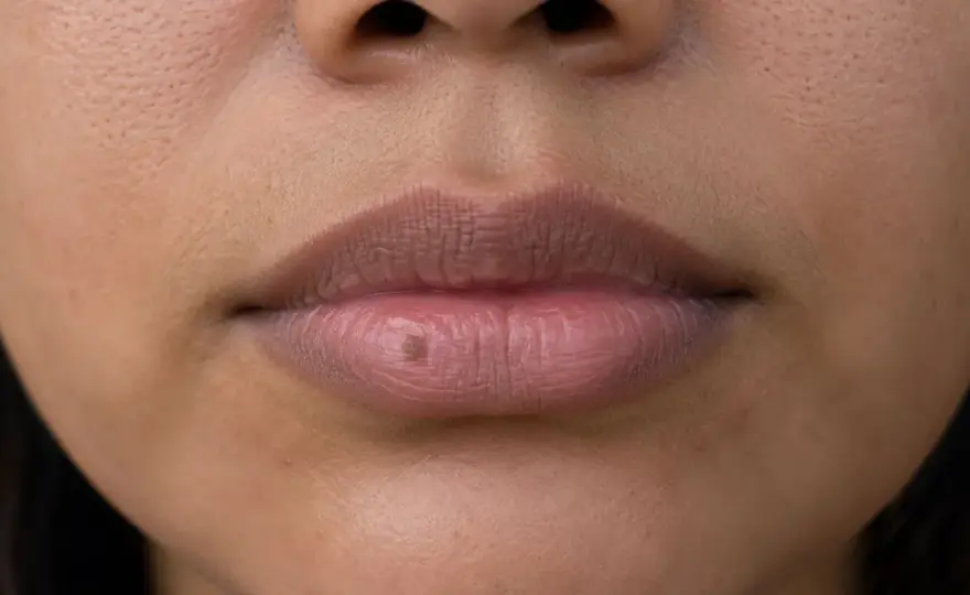 ¿Un lunar en el labio de repente? Cuándo conviene revisarlo