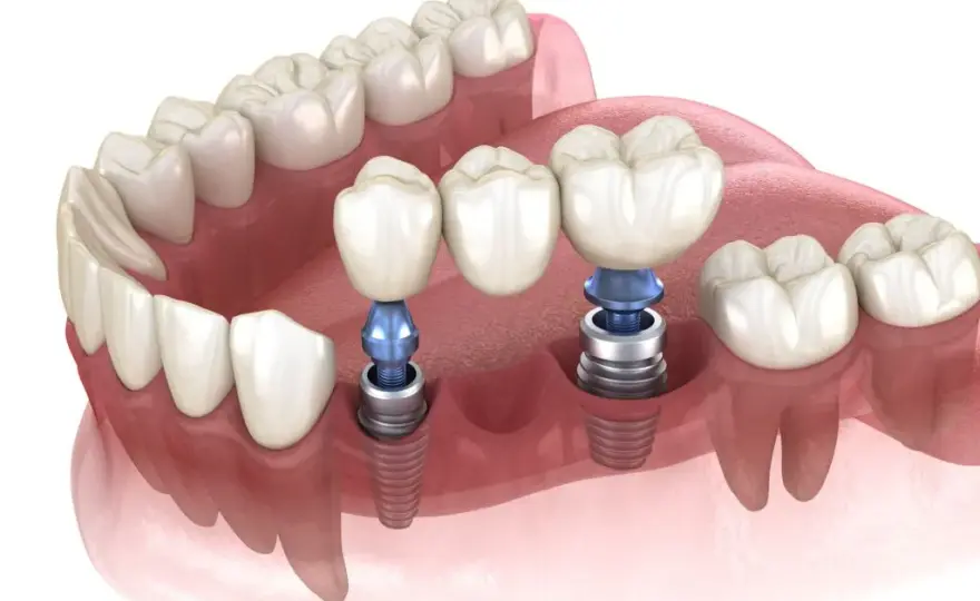Koszt implantu zęba w Polsce: Pełna cena i co wpływa na nią?