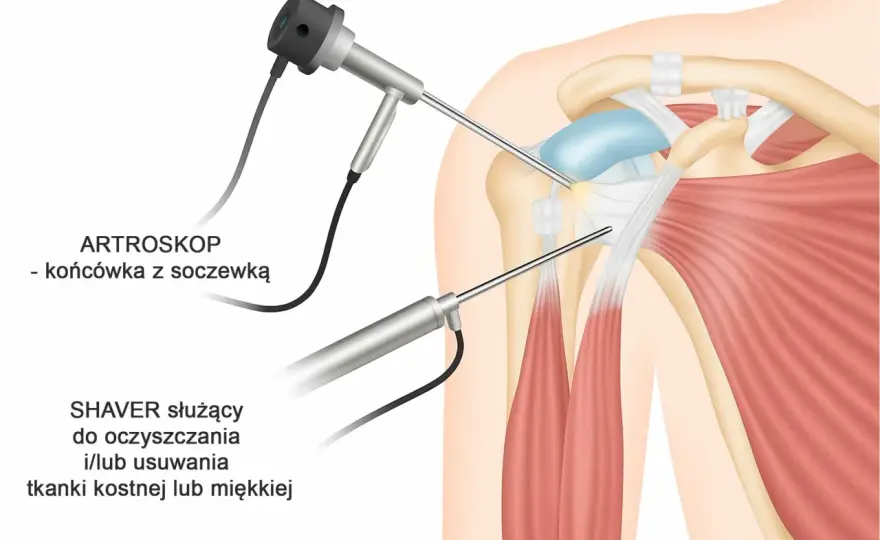 Ból ręki w ramieniu - Czy to coś poważnego? Przyczyny i leczenie